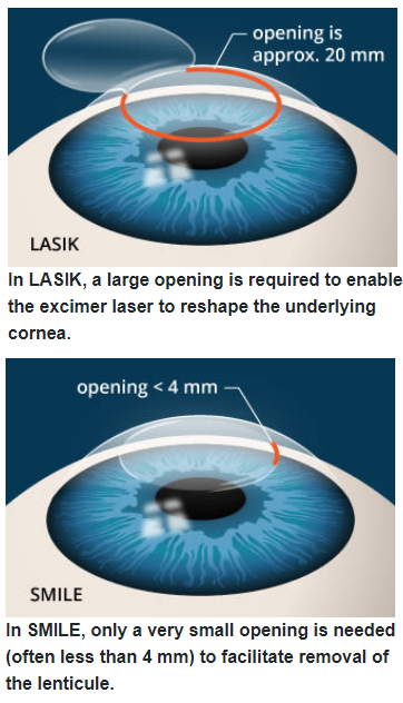 Smile Lasik