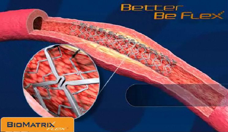 Biosensors_stent